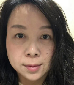 去眼袋手术