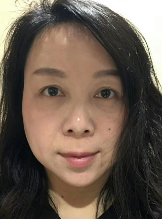 去眼袋手术