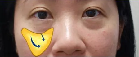 去眼袋手术