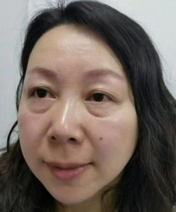 去眼袋手术