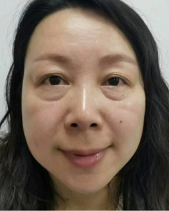 去眼袋手术