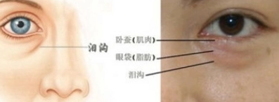 去眼袋手术