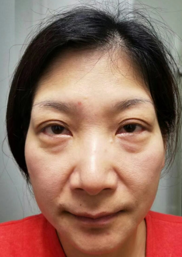 去眼袋手术