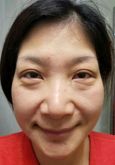 去眼袋手术
