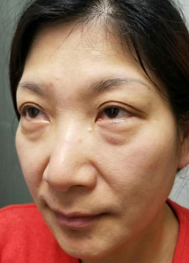 去眼袋手术