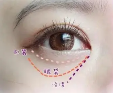 去眼袋手术