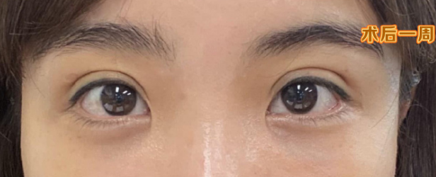 眼袋