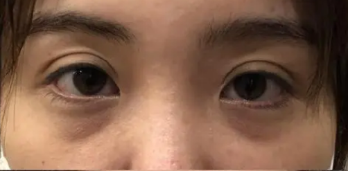 眼袋