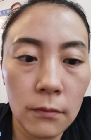 眼袋
