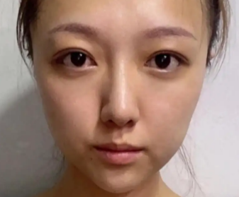 去眼袋手术