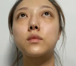 去眼袋手术