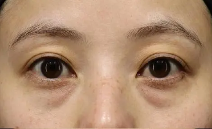 去眼袋手术