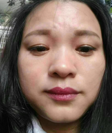 去眼袋手术