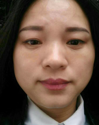 去眼袋手术