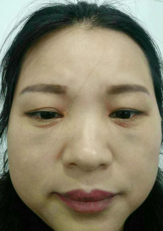 去眼袋手术
