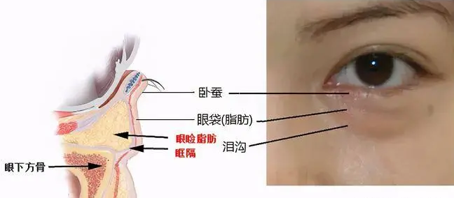 去眼袋手术
