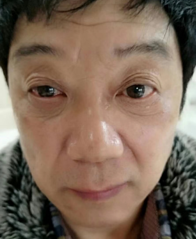 去眼袋手术