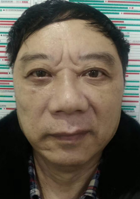去眼袋手术