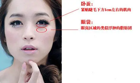 去眼袋手术