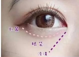 去眼袋手术