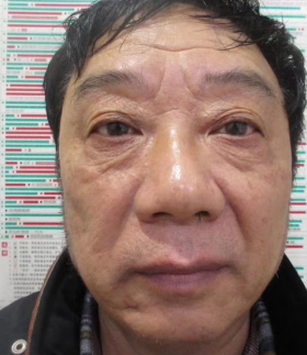 去眼袋手术
