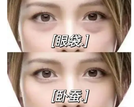 去眼袋手术