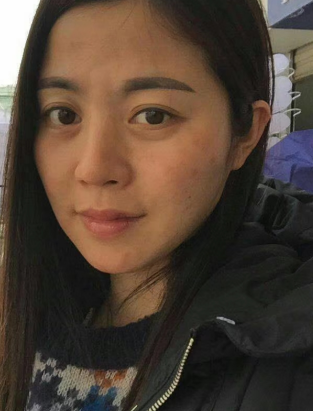 去眼袋手术