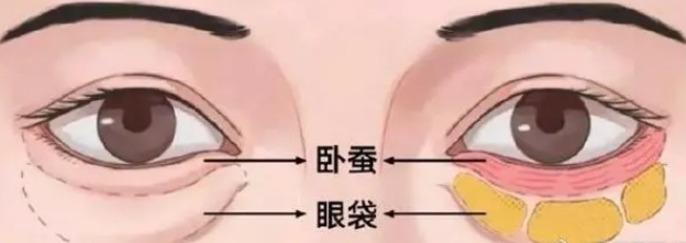 去眼袋手术