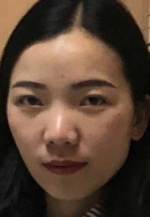 去眼袋手术