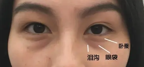 去眼袋手术