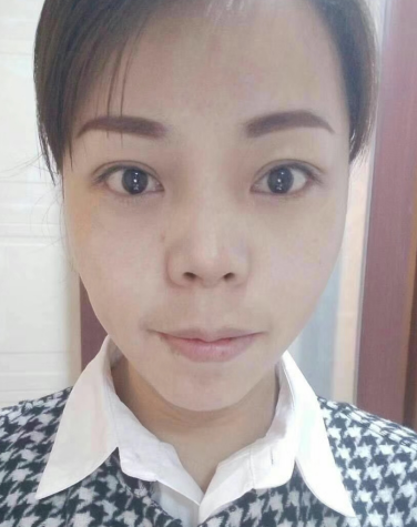 去眼袋手术