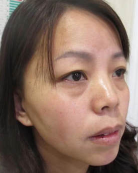 去眼袋手术