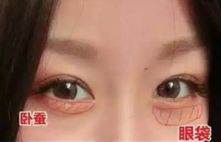 去眼袋手术
