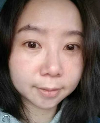 去眼袋手术