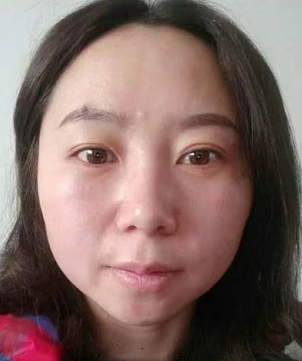 去眼袋手术