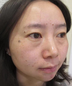 去眼袋手术