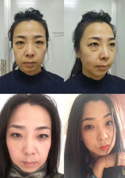 去眼袋手术