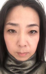 去眼袋手术