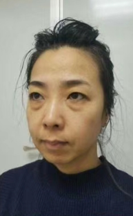 去眼袋手术
