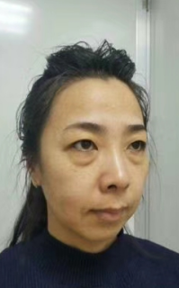 去眼袋手术