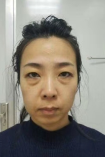去眼袋手术