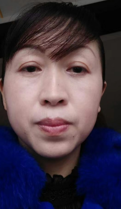 去眼袋手术