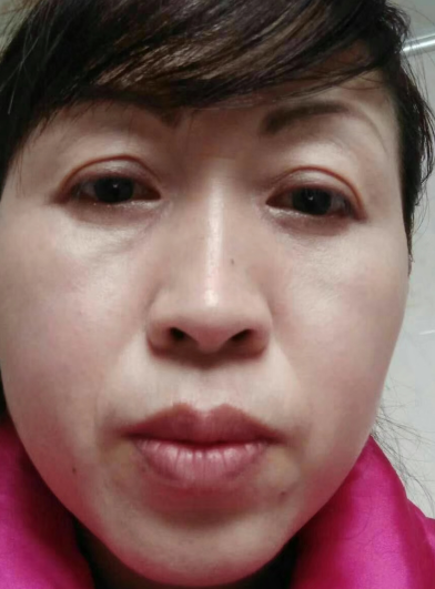 去眼袋手术