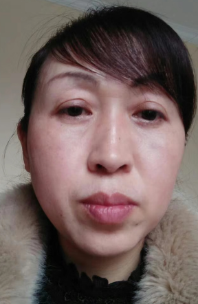 去眼袋手术