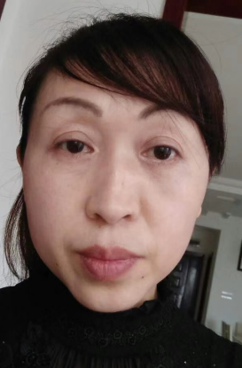 去眼袋手术