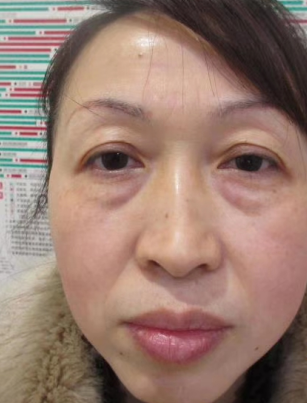 去眼袋手术
