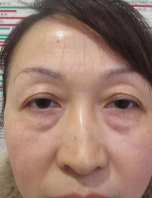 去眼袋手术