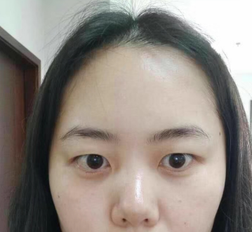 去眼袋手术