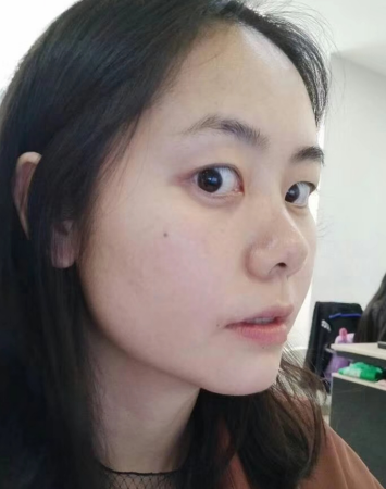 去眼袋手术