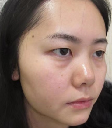 去眼袋手术